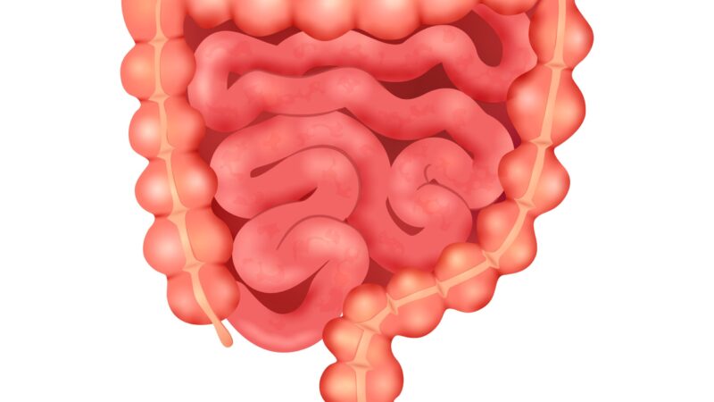 Sindrome del colon irritabile: dolore addominale e lombare
