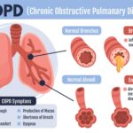 Manipolazione della pompa linfatica in pazienti con BPCO - Dott. Massimo Mapelli Osteopata Bresso